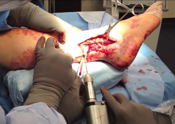 ankle fracture ankle fracture