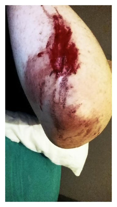Road rash...it is the new black! http://t.co/tkbHTlwekn
