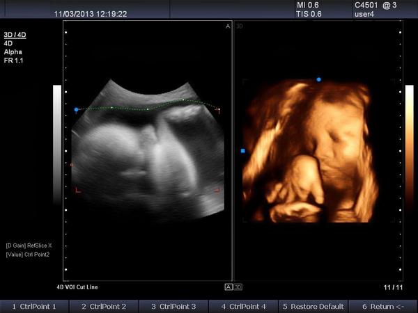 узи с доплером при беременности 3 триместр. узи допплерометрия беременных. узи с доплером при беременности 3 триместр. средняя мозговая артерия плода допплер. узи с доплером при беременности 3 триместр.