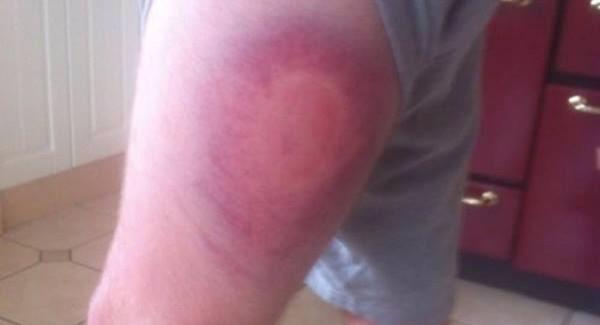 UnOfficialGaa's tweet photo. BREAKING
Waterford goalkeeper Stephen O'Keefe confirmed the bruise he received from Nash finally went last night #GAA http://t.co/aQQeqmmrVs