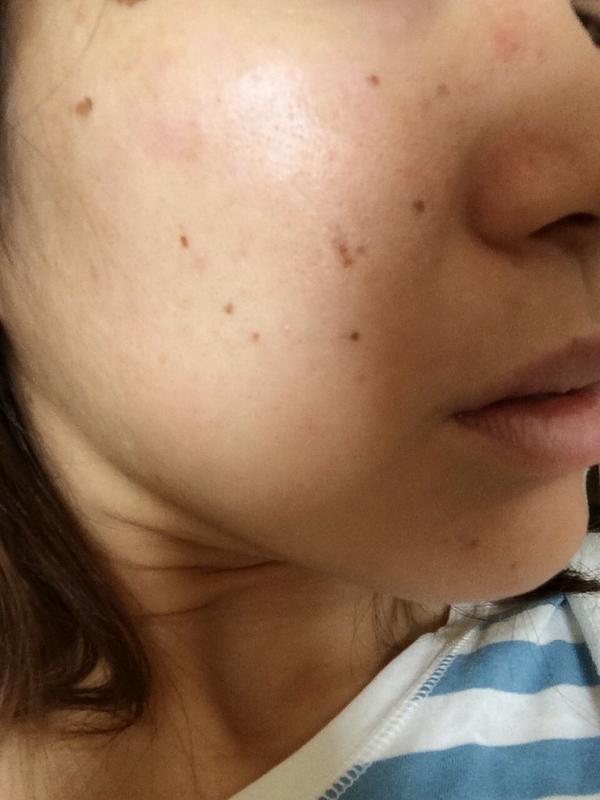 しみ撃墜隊 Sur Twitter シミとり7日目 レーザー受けてから1週間経ちました 日々ポロととれるので 実感してなかったけど見て すごい綺麗になりつつある シミ しみとり 美容 しみ撃墜隊 Http T Co Nqldhfypcl