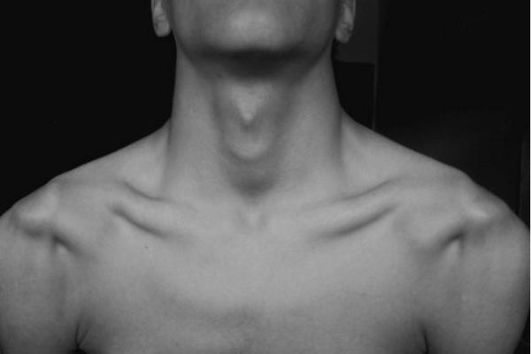 Тянет кадык. Тянет кадык. Болит кадык при глотании. Сильная боль в горле причины. Тянет кадык.