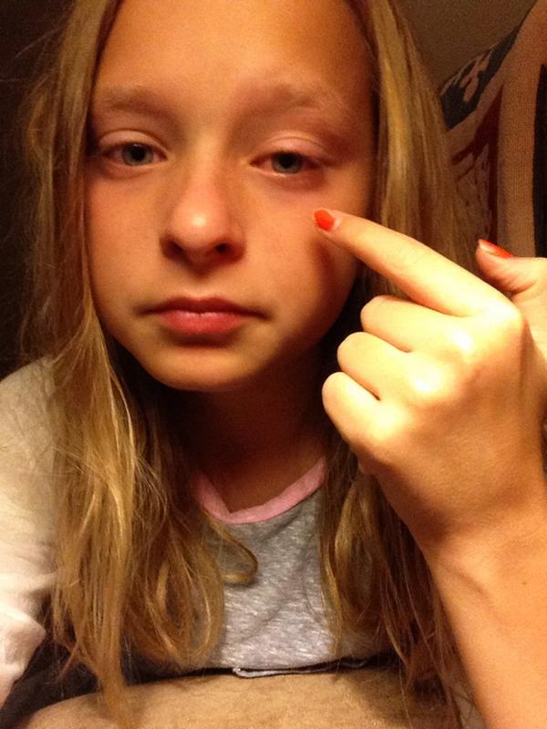 Anna Pottorff On Twitter Swollen Eye Sore Throat Ear Pain Headache Not A Good Night Please Someone Kill Meh Now Jk Http T Co Vtnxufv9rk
