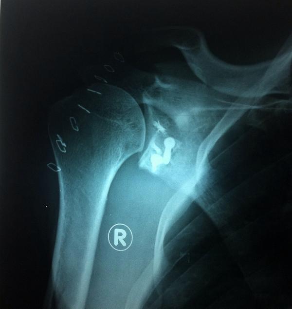 Aashhosp's tweet photo. Recurrent dislocation of shoulder with Bone loss of socket. Glenoid restoration by using bone graft in a young man http://t.co/Kx1m341PQD