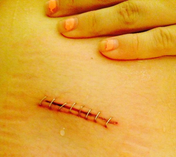 lauren_norris3's tweet photo. Annah survived💪 #appendixgone http://t.co/f0rmo9fyGN