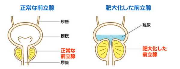 O Xrhsths ゴロ 解剖生理イラスト Sto Twitter 前立腺肥大は なぜ残尿感があるのかが分かる図 T Co Uiktztbgcp