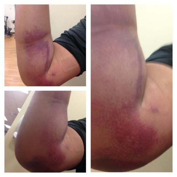 JULIOCHATO75's tweet image. GATA! 🔷🔶🔹🔸 #hyperextended #sprained #elbows