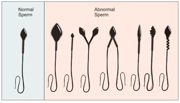 Morphology sperm treatment