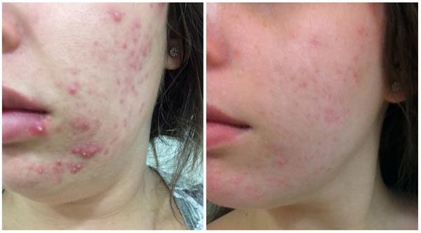 Clearetto's tweet photo. Beatriz's daughter has been on @Clearetto 6 wks, and the results are remarkable! #acne #skin #finallyclear #Clearetto http://t.co/CvsRCIlHE2