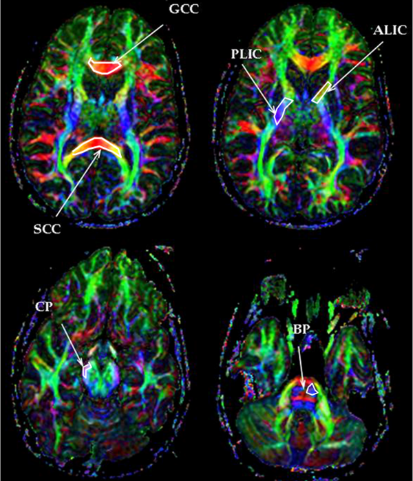 InfoBIM's tweet photo. Journal of Neuroscience Research imágenes de los pacientes con proteína proteolipídica gen 1. http://t.co/NcGKfv10nv http://t.co/WiqKhcrVjX