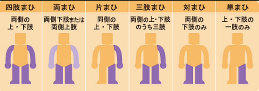 تويتر ゴロ 解剖生理イラスト على تويتر ひと目で分かる麻痺の種類 片麻痺と対麻痺がよく試験に出ます T Co 4ptknavy71