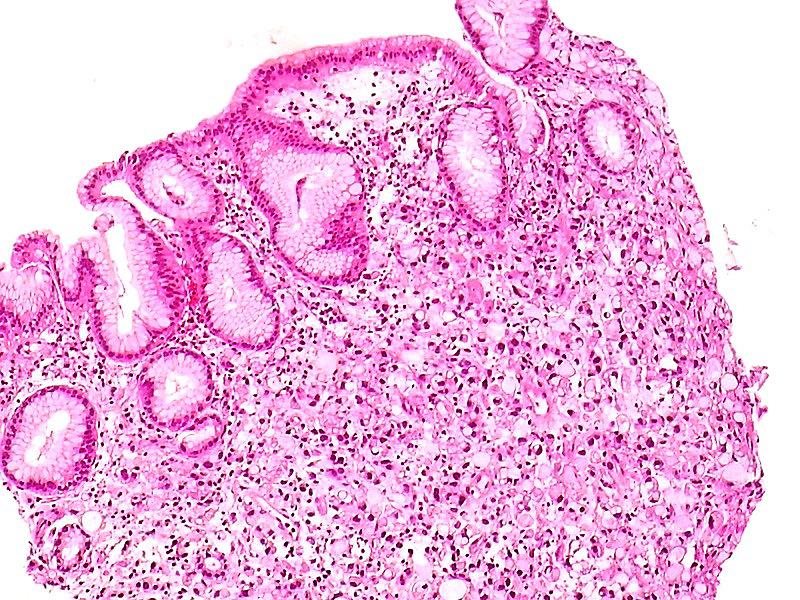 Cardenal mineral Disipar Anapat on Twitter: "Estómago. Carcinoma gástrico difuso con células en  anillo de sello. Tinción HE (1) http://t.co/KrOZ7RNsa8" / Twitter
