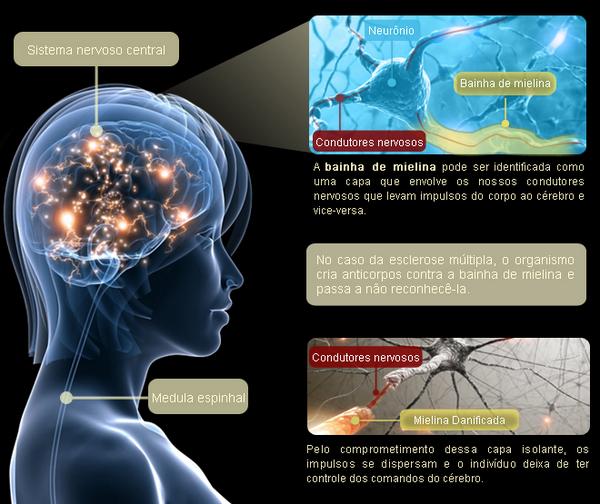 torquatoraphael's tweet photo. #EscleroseMúltipla http://t.co/Uoum5SZQqr