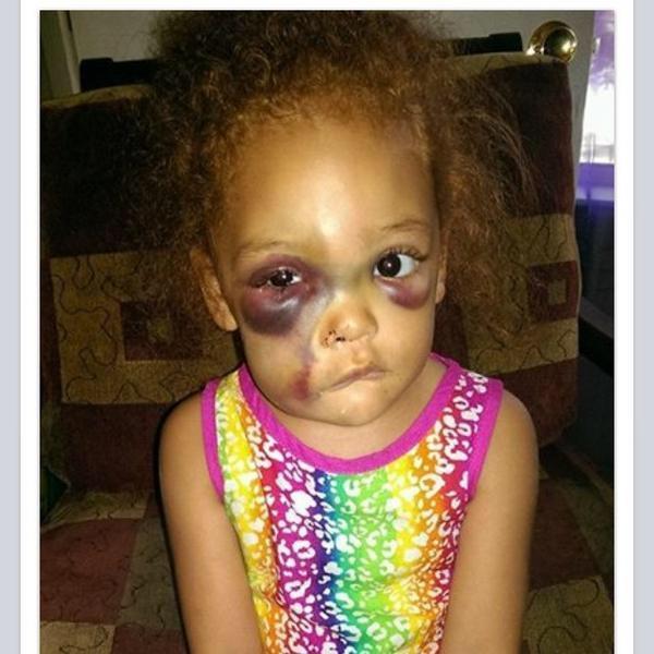 ITGlobalNews's tweet photo. How is #AvaLynn today? Please RT #JusticeForAvaLynn Cant stop crying... #EvilWorld... This evil act must be condemned http://t.co/PBNJ3he7hQ