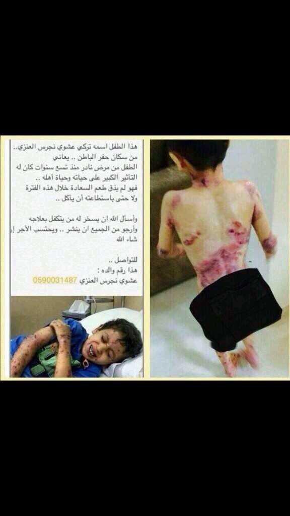 sgvdg1's tweet photo. عاجل 📢

#الطفل_تركي_عشوي_العنزي يعاني من مرض
 غريب ونادر يحتاج منكم الدعاء ومن يتكفل بعلاجه
 #الطفل_تركي_عشوي_العنزي http://t.co/h9WqVQyoji”