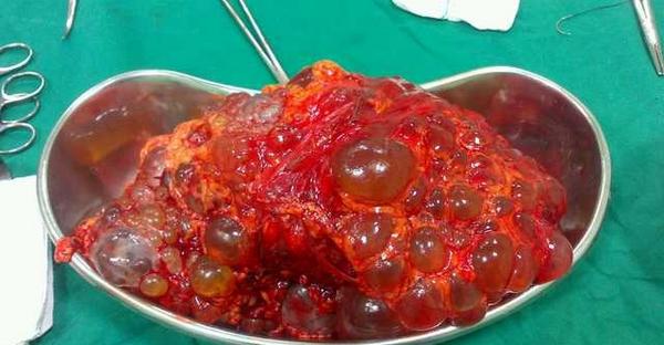 MedicalPorn's tweet photo. Polycystic kidney. http://t.co/drwnury3h1