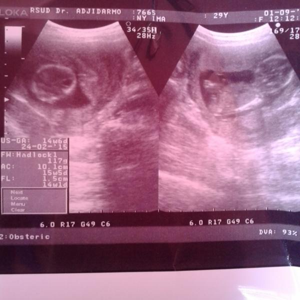 ima_TP's tweet photo. Usg ke 2 alhamdulillah udah 14w,udah mulai terlihat bentuk kepala. Kita sehat bersama @PrenagenWorld yaa baby ^^ http://t.co/lZsAWHXafx
