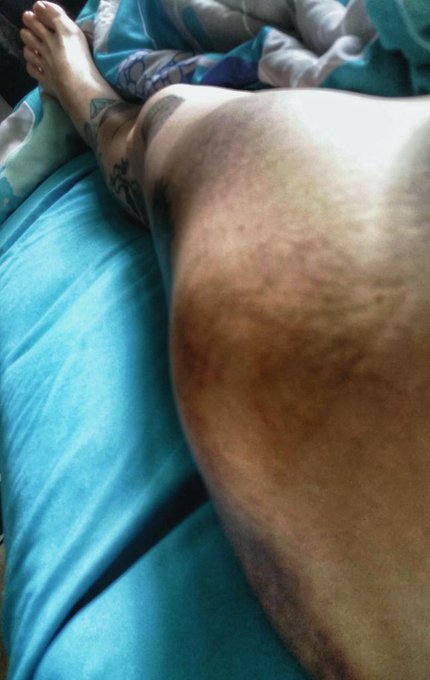 Tired of being busted up! Motorcycle is done. I STILL look &amp; feel like I am as well. http://t.co/eLR<a href="/tag/freyjavansiren"class="tags"><span>#freyjavansiren</span></a><a href="/tag/caferacergirl"class="tags"><span>#caferacergirl</span></a><a href="/tag/bulldogpride"class="tags"><span>#bulldogpride</span></a>