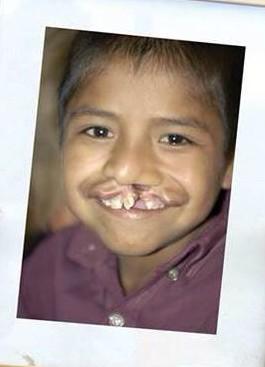 zorellin's tweet photo. Cirugías #Labioleporino y #PaladarHendido GRATIS. Jornada Médica en Puebla(Nov.7-15) ayuda compartir y cambiar vidas http://t.co/6iLmbOHcqG
