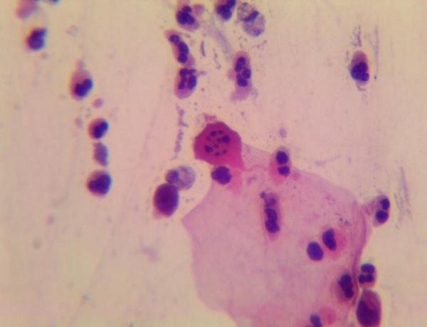 APyCitologia's tweet photo. "@CitologiaVzla: Cariorrexis http://t.co/aXoOsT8zwW"