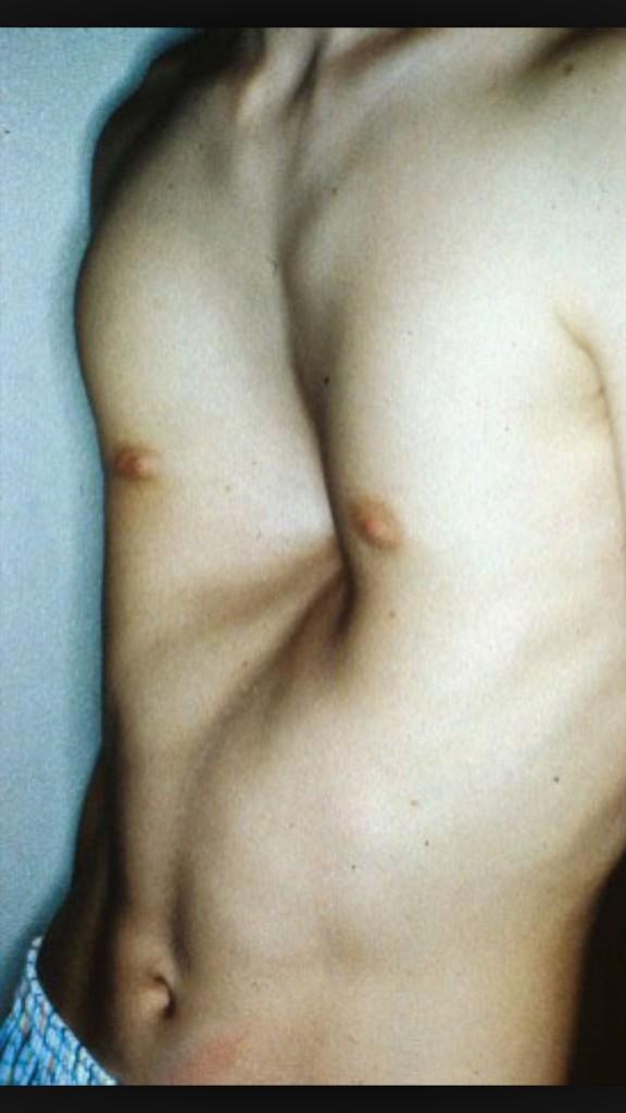 MedicalPorn's tweet photo. Pectins excavatum. Learned about this in embryology today. http://t.co/taRL3vYXVG