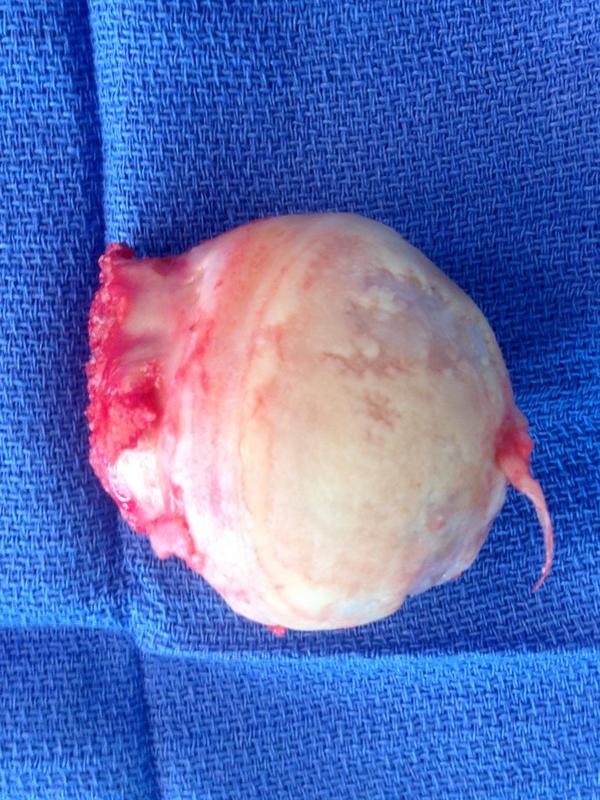 Dr_Cirujano's tweet photo. Hip arthroplasty... Anterior approach #hueter http://t.co/8kS97Fpgxo
