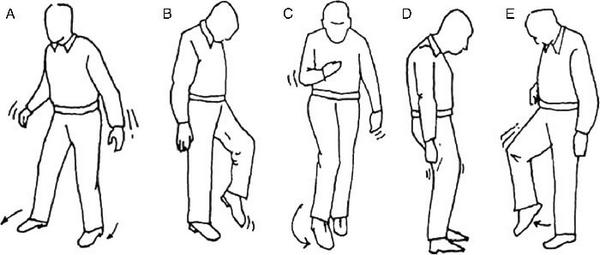 Виды походок. Нарушение движения при ходьбе. Нарушение движения при ходьбе. Человек нарушение координации. Нарушение координации движения.