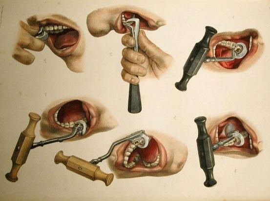 juneceramic's tweet image. Dentistry in the dark days before novocaine - boingboing.net/2014/09/03/den…