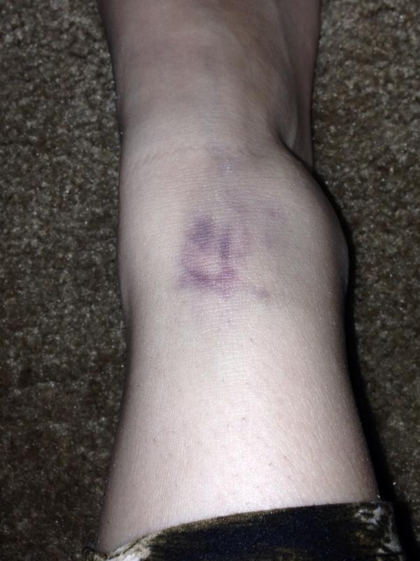 MinervaDaisy's tweet photo. This Nast bruise I got on my foot http://t.co/nqIiwswbWv