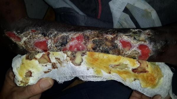 AddictsUnite's tweet image. Took this picture myself in hospital. Krokodil is most certainly a reality and now in Port Elizabeth South Africa.