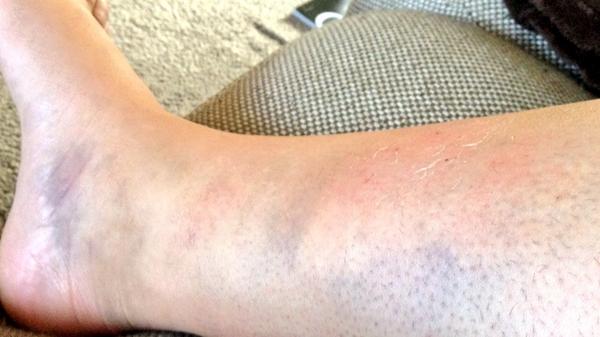 ashleylinsley's tweet photo. Leg looking great after toilet related accident at #bestival - more ice me thinks 👏😫 http://t.co/4YSmsBbgqh