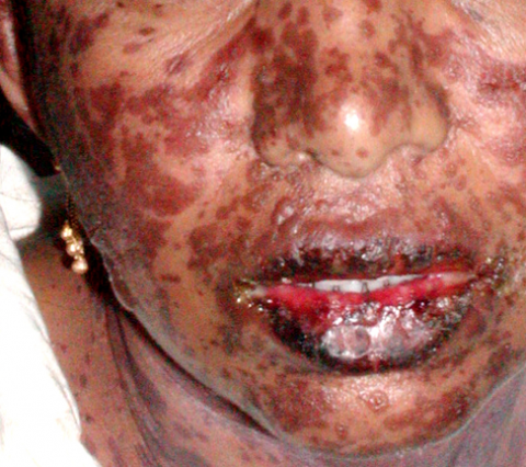plomoparejo's tweet photo. La epidemia en el HC de Maracay es "Meningococcemia" (sangre contaminada). http://t.co/6BpplqKNrK