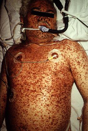 plomoparejo's tweet photo. La epidemia en el HC de Maracay es "Meningococcemia" (sangre contaminada). http://t.co/6BpplqKNrK