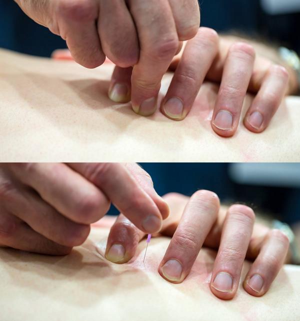 Acupunct_Med's tweet image. RT @BMAS_News: New guidance on safe needling over the thorax from the BMAS #acupuncture medical-acupuncture.co.uk/Default.aspx?t…