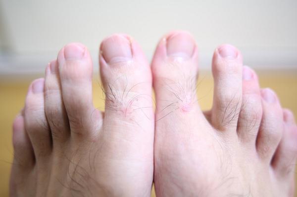 REVIEWSRUNNING's tweet image. #大山式ボディメイクパッド  #使用レビュー ツイート！！
【5日目】左の足指が腫れてる〜。
#ダイエット #股関節痛  #Ｏ脚矯正