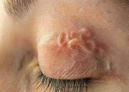 Dirofilariasis causada por infeccion con Dirofilaria. Filaria transmitida x mosquito. Vía malformalady