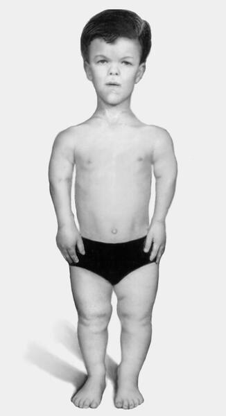 Рост человека с возрастом. Нарушение роста и развития ребенка. Ребенок растет и развивается. Семиотика нарушений у детей. Нарушение роста и развития ребенка.