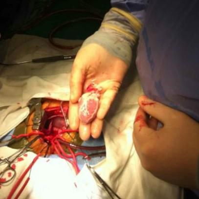 MedicalPorn's tweet photo. Heart transplant in a 13 month old via figure 1. http://t.co/rWEGsKXtAo