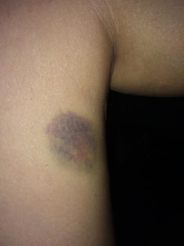 Paquette72's tweet photo. My war wounds from the #ChicagoSuper If I didn't have these then I wasn't trying hard enough @SpartanRace http://t.co/POwmQq1FTw