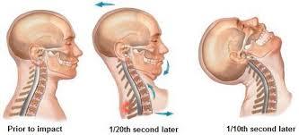 Many suffer symptoms 6-12 months after a Motor Vehicle Accident. Early management helps minimize on-going problems!
