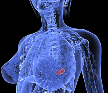 RivertownsHH's tweet photo. Three-dimensional (#3D) images in actual 3D might help #Doctors find hidden tumors and bet... http://t.co/jtbM0sZtQ1 http://t.co/OjVQQEK06L