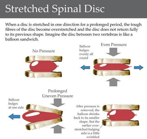 NJSpineWellness's tweet image. Do you know what a stretched spinal disc is?

#wellness #spine #spinaldisc #chiro #chiropractor #backpain