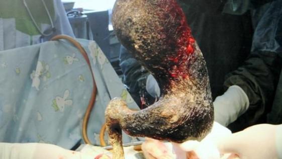 EnterateES's tweet photo. Le Sacan Una Bola De Pelo De 4 Kg De Su Estómago. Mira Cómo Llego Ahí http://t.co/D0nyDllxyu http://t.co/sp4sFA6qTw