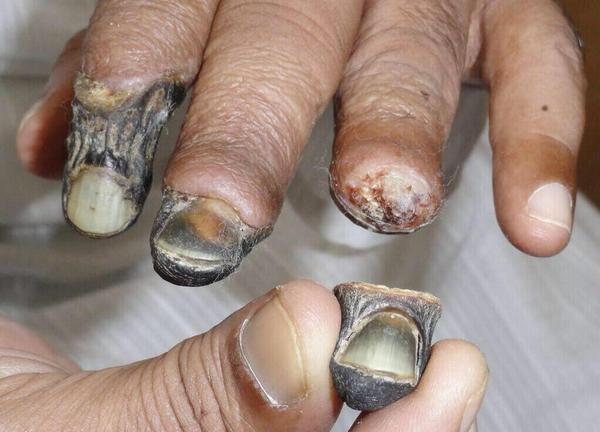 TerrifyingPics's tweet photo. This is what the new street drug named Krokodil does to you http://t.co/ioDkgn753z