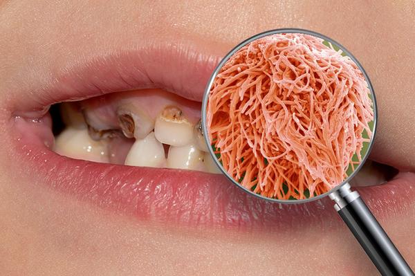 SciGuySpace's tweet photo. What plaque looks like under a microscope - be sure to brush your teeth kids!
http://t.co/YMNjUdWAXU http://t.co/oiVJLzaJ89
