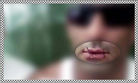 clickhereAU's tweet photo. Nauru #asylumseekers Sew Lips Shut in Protest over #Cambodia Transfer!✍#BenDoherty☞http://t.co/WK0624bP8m #auspol http://t.co/lKOgsGuT7y