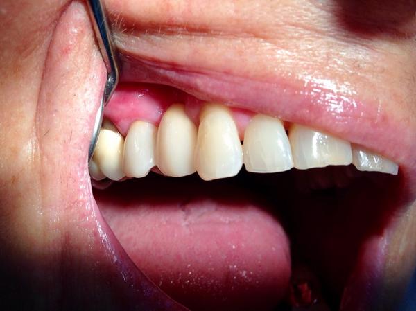 TandartsAdding's tweet image. Tevreden patiënt met een #cerec brug. Mooi werk!