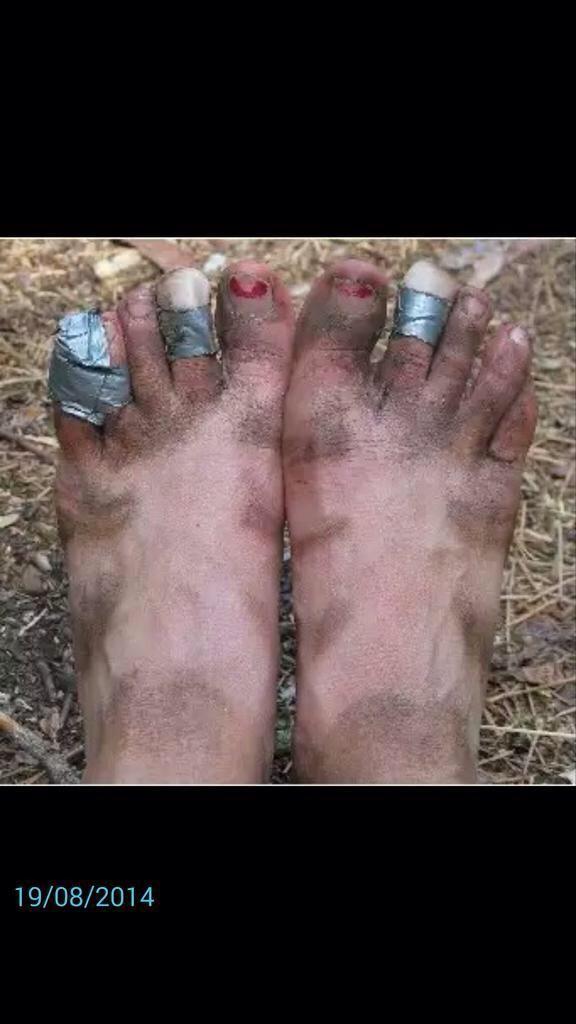 severnsidefc's tweet photo. @08Woodsy feet after today's game... #nailsstillon #tapeyourtoes 😂😂 http://t.co/XJlBmLKwmb