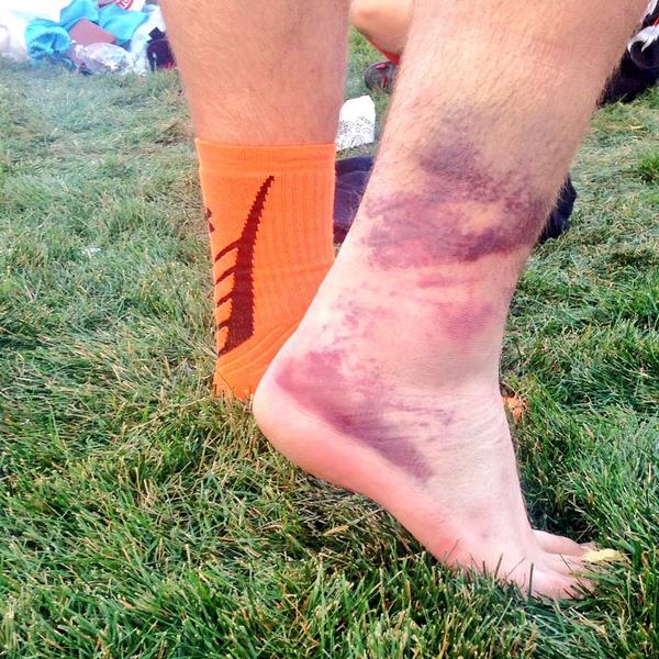 bgsuquadball's tweet photo. "Hey guys, I honestly don't understand why I can't play the next game. I'm totally fine." #quidditchproblems http://t.co/CD4TGjqC9u