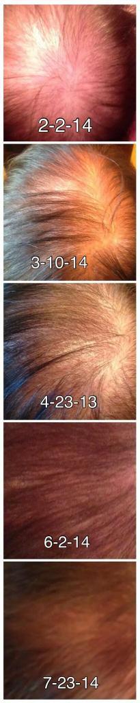 AllanpierceAp's tweet photo. #CleanUpYourMeshBayer #CleanUpYourMeshFDA essure hair comes back after removal. Stop essure!!! http://t.co/RSUUgmLmCj